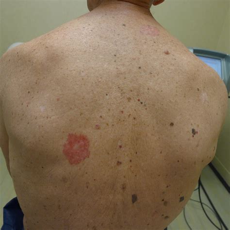melanoma spots on back over spa